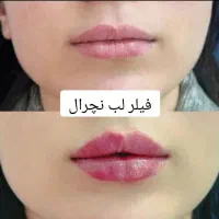 جشنواره بوتاکس/فیلر/مزوتراپی/پی آر پی  توسط پزشک|خدمات آرایشگری و زیبایی|زنجان, |دیوار