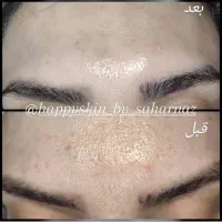 مدل فیشیال وی ای پی و درمان جوش|خدمات آرایشگری و زیبایی|تهران, مجیدیه|دیوار