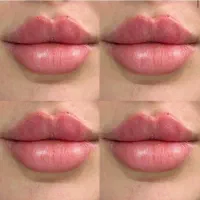 تخفیفات یلدایی فیلروبوتاکس