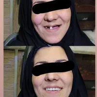 دندان دندانسازی پروتز با چک|خدمات آرایشگری و زیبایی|مشهد, موعود|دیوار