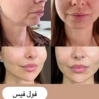 فیلر لیفت بینی و صورت وشقیقه مزوتراپی بوتاکس|خدمات آرایشگری و زیبایی|تهران, تهرانپارس جنوبی|دیوار