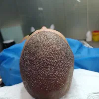 کاشت مو به روش Sp|خدمات آرایشگری و زیبایی|آذرشهر, |دیوار