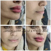 برداشتن خال کک مک منگوله گوشتی لک در یک جلسه ژل|خدمات آرایشگری و زیبایی|گلستان (تهران), |دیوار