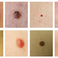 برداشتن خال و زگیل