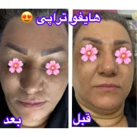 پلاژن تراپی /هایفو تراپی /لیزر بدن/کربوکسی|آرایشگاه و سالن‌های زیبایی|مشهد, کارگران|دیوار