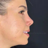 عمل جراحی بینی با پیزو فقط23/ ترمیم/مشاوره رایگان|خدمات آرایشگری و زیبایی|تهران, ونک|دیوار