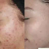 زیبایی صورت.|خدمات آرایشگری و زیبایی|بروجرد, |دیوار