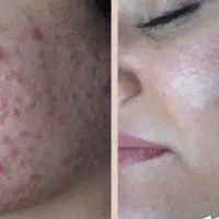 پوست صاف و بدون جوش رو با ما تجربه کنید