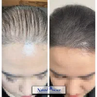 رفع کم پشتی مو با میکرو اسکالپ/ جایگزین کاشت مو|خدمات آرایشگری و زیبایی|مشهد, وکیلآباد|دیوار