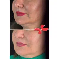 شادابی و جوانسازی صورت با تزریق پروفایلو|خدمات زیبایی و سلامت|شیراز, معالیآباد|دیوار