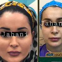 کانتورینگ صورت