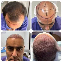 کاشت مو - ما مدعی بهترین کاشت مو هستیم|خدمات زیبایی و سلامت|تهران, سعادتآباد|دیوار