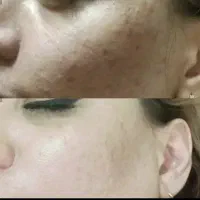 کرم  ضد لک و سفید کننده تضمینی|آرایشی، بهداشتی، درمانی|کیش, |دیوار