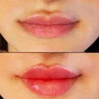 تزریق ژل و بوتاکس و فیلر بادی باتخفیف توسط پزشک
