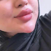 تزریق تخصصی ژل لب تزریق بادی لیفت نخ و چربی|خدمات آرایشگری و زیبایی|خرمشهر, |دیوار