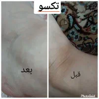 رفع تیرگی ، ناباروری،  چاقی صورت و بدن ، لاغری|آرایشی، بهداشتی، درمانی|زاهدان, |دیوار