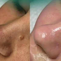 پاکسازی تخصصی پوست /فشیال/