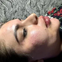 معتبرترین مرکز برداشت کامل غبغب