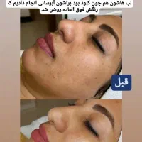 تخفیف ویژه پاکسازی پوست