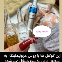 مزونیدلینگ فشیال کرم پودر لیزر جوش خال کربن تراپی