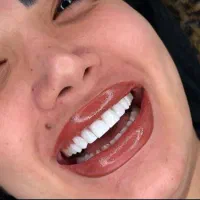 کامپوزیت دندان از فکی 4 تومن