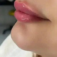 تخفیف ویژه بوتاکس فیلر