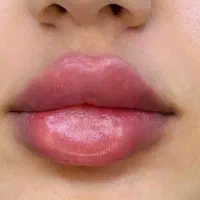 تزریق ژل و بوتاکس و کاشت نخ و مزوژل های جوان ساز