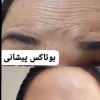 اف تابستانه زیبایی تزریق ژل، بوتاکس، پی ار پی|خدمات آرایشگری و زیبایی|اهواز, کمپلو جنوبی|دیوار