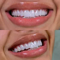 خدمات دندانپزشکی ازدم قسط/کامپوزیت/لمینت/روکش/|خدمات آرایشگری و زیبایی|تهران, سلسبیل شمالی|دیوار