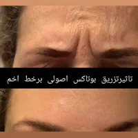 تزریق تخصصی ژل و بوتاکس رشت|خدمات آرایشگری و زیبایی|رشت, بلوار گیلان|دیوار
