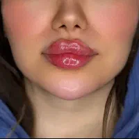 فیلرلب(ژل)بوتاکسلیفتنخمزوجوانساز