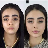 جشنواره ژل،بوتاکس،هایفو،بلفارو،انواع جراحی زیبایی