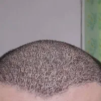 بلفارو .کاشت مو ابرو و ریش