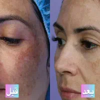 پی ار پی صورت،prp مو ،میکرو و مزونیدلینگ،مزوتراپی