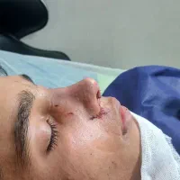 عمل بینی 23میلیون