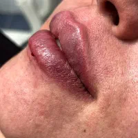 ژل لب فیلر بوتاکس پی ار پی فیلر گونه خط خنده|خدمات آرایشگری و زیبایی|کاشان, طالقانی|دیوار