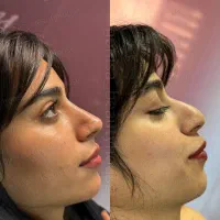 ژل و بوتاکس فیلرلب کانتورینگ جوانسازی هایفو فیشال
