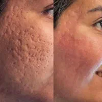 مزوتراپی ، PRP و مزونیدلینگ|خدمات آرایشگری و زیبایی|دوگنبدان, |دیوار