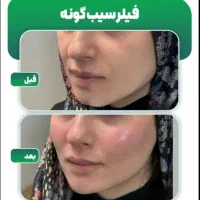 فیلر * بوتاکس * ژل