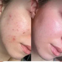 کلینیک تخصصی درمان آکنه ( جوش ) عفیف اباد|خدمات آرایشگری و زیبایی|شیراز, عفیف‌آباد|دیوار