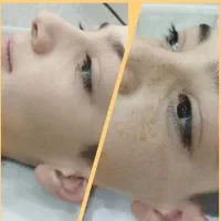 ریموو تتو با لیزر کیوسوییچ|خدمات آرایشگری و زیبایی|خرم‌آباد, |دیوار