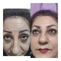 آفر۵۰ درصدی تزریق ژل و بوتاکس ب مدت محدود|خدمات آرایشگری و زیبایی|تهران, نارمک|دیوار