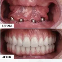 جشنواره دندانپزشکی ایمپلنت ۱۰/۳۰۰|خدمات آرایشگری و زیبایی|سلماس, |دیوار