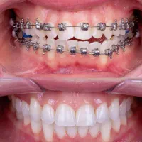 ارتودنسی با اقساط اختصاصی متناسب با بودجه شما