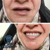 کلینک تخصصی دندان مصنوعی فقط 6.800|خدمات آرایشگری و زیبایی|بهارستان, |دیوار