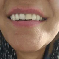 دندان مصنوعی با بهترین کیفیت و قیمت پایین|خدمات آرایشگری و زیبایی|نیشابور, سرآب کوشک|دیوار