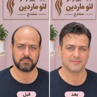 یک روش جدید. برای رفع تاسی