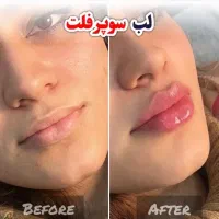 تخفیفات ژل و بوتاکس و نخ توسط شخص دکترچابکی