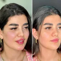 تزریق ژل لب،بوتاکس،زاویه سازی