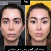 لیفت فول فیس صورت لیفت چشم گربه ای بدون عمل جراحی|خدمات آرایشگری و زیبایی|ری, دیلمان|دیوار
